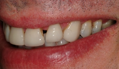 Closeup of man's smile with older worn dental restorations on front teeth