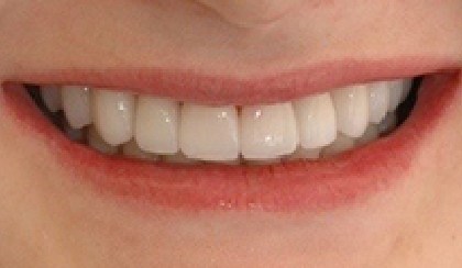Closeup of perfected smile after braces and smile makeover