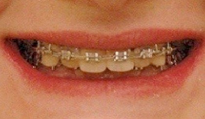 Closeup of teen's smile with braces