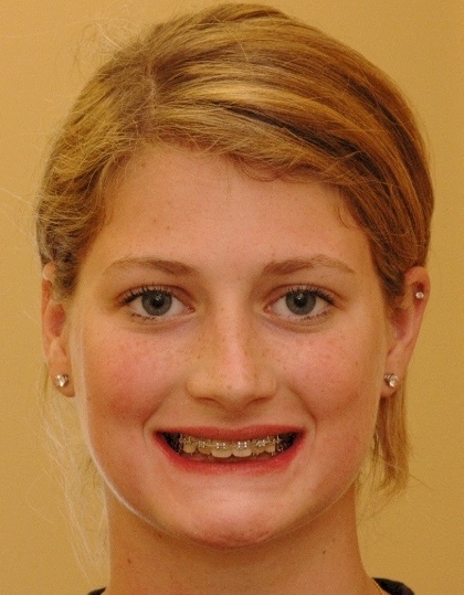 Teen girl with braces