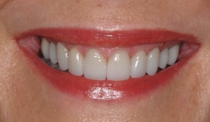 Closeup of female dental patient's transformed smile after porcelain veneers and dental crowns
