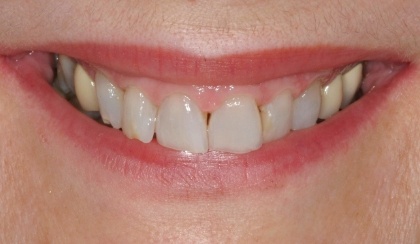 Closeup of female dental patient's flawed smile