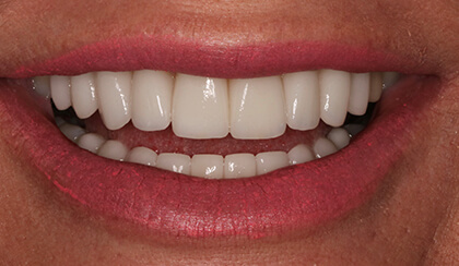 Closeup of dental patient's beautiful smile after porcelain veneers