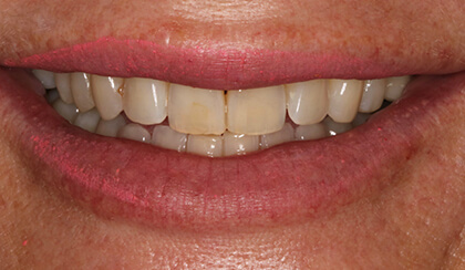 Closeup of dental patient's discolored and misaligned smile