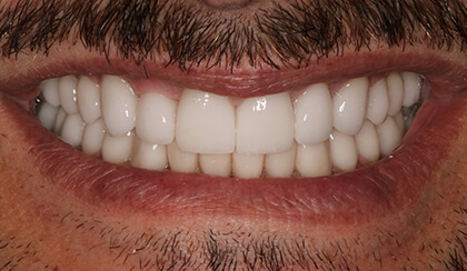 Closeup of man's gorgeous smile after cosmetic dentistry