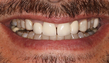 Closeup of man's discolored dental crowns before cosmetic dentistry