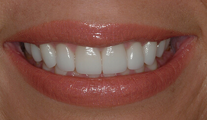 Closeup of young woman's flawless smile after porcelain veneers