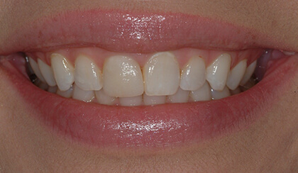 Closeup of young woman's imperfect smile before porcelain veneers