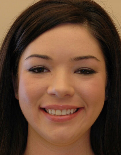 Young woman with imperfect smile before porcelain veneers