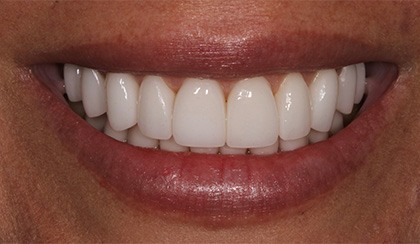 Closeup of young woman's flawless smile after porcelain veneers