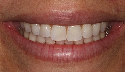 Closeup of young woman's imperfect smile before porcelain veneers