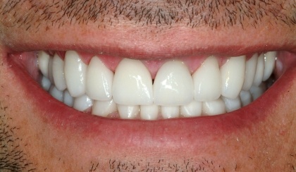 Closeup of flawless smile after full mouth reconstruction