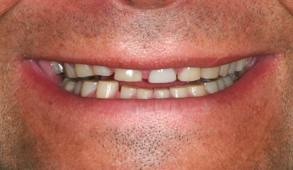 Closeup of man's worn teeth before full mouth reconstruction