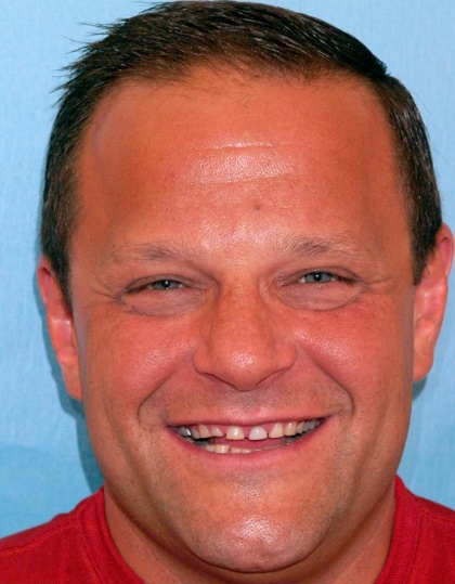 Man with worn teeth smiling before full mouth reconstruction