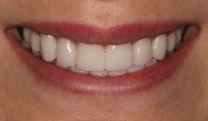 Closeup of patient's perfected smile after porcelain veneers