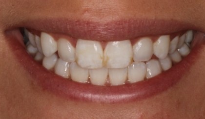 Closeup of patient's imperfect smile before porcelain veneers