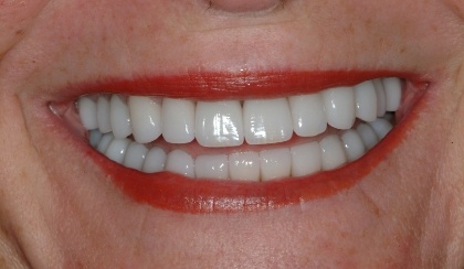 Closeup of woman's perfected smile after porcelain veneers and dental crowns