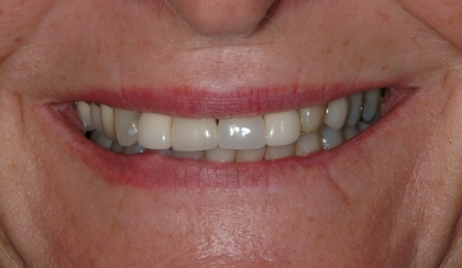 Closeup of woman's flawed smile before porcelain veneers and dental crowns