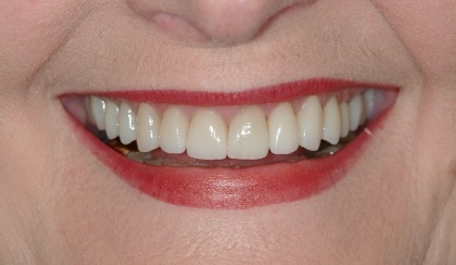 Closeup of woman's flawless smile after orthodontics porcelain veneers and dental crowns