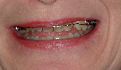 Closeup of flawed and misaligned teeth during orthodontic treatment
