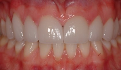 Closeup of woman's flawless smile after porcelain veneer treatment