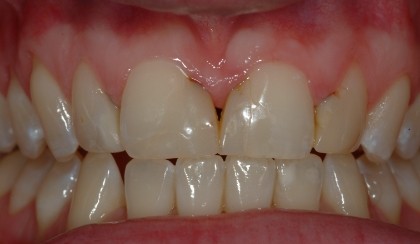 Closeup of woman's discolored dental bonding and imperfect smile