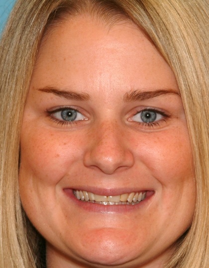 Woman with discolored dental bonding and imperfect smile