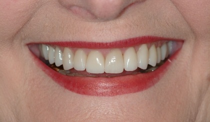 Closeup of woman's transformed smile after porcelain veneers
