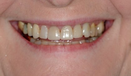 Closeup of woman's imperfect smile before porcelain veneers