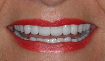 Closeup of woman's perfected smile after full mouth reconstructio