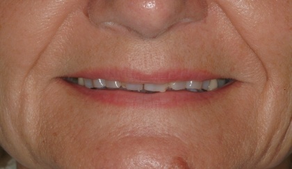 Closeup of woman's imperfect smile before full mouth reconstruction
