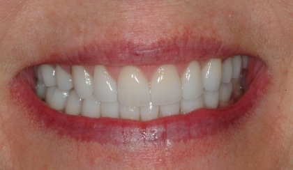 Closeup of patient's gorgeous smile after porecelain veneers and dental crowns