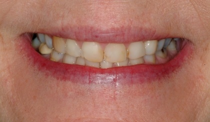 Closeup of patient's worn and discolored smile after cosmetic dentistry