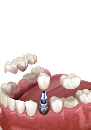 Animated smile during dental implant suppported tooth replacement and fixed bridge placement