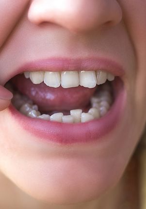 Woman with crowded teeth