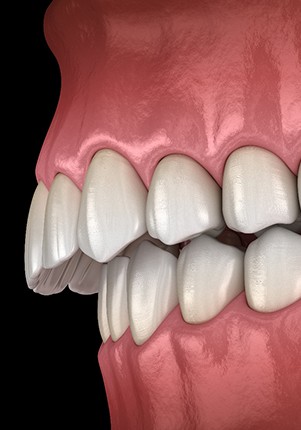 Digital illustration of an overbite