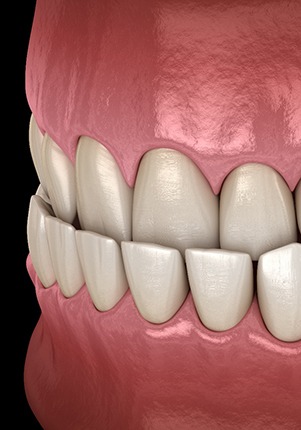 Digital illustration of an underbite