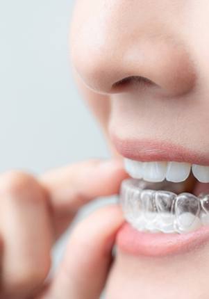 Patient placing clear aligner on bottom teeth