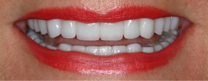 Closeup of Joanne's smile after smile makeover