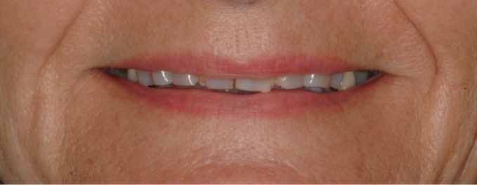 Closeup of Joanne's smile before smile makeover