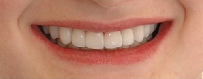 Closeup of Rebecca's smile after smile makeover
