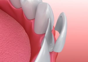 veneers applied 3D illustration 